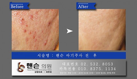 아기주사 전후사진입니다　　 