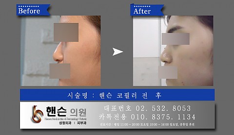 코필러 전후사진입니다　　　 