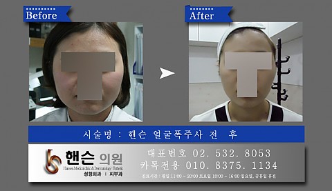 얼굴폭주사 전후사진입니다 