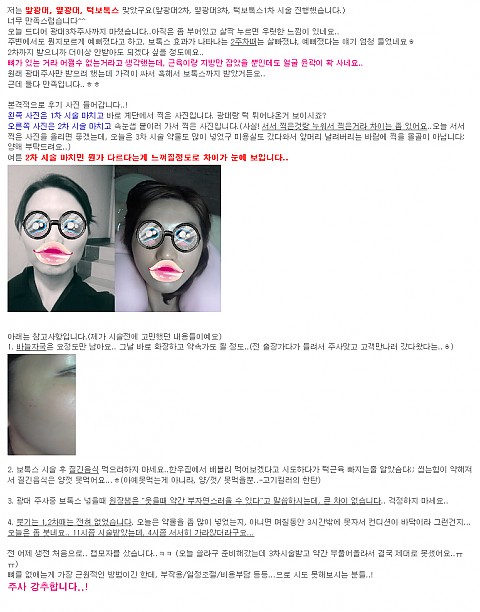 광대주사 + 보톡스 후기 