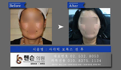 사각턱보톡스 전후사진입니다 