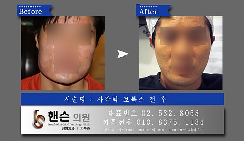 사각턱보톡스 전후사진입니다 
