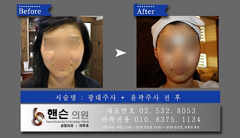 광대주사 + 윤곽주사 전후사진입니다 