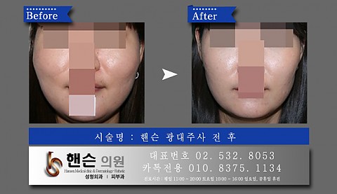 광대주사 전후사진입니다　　 