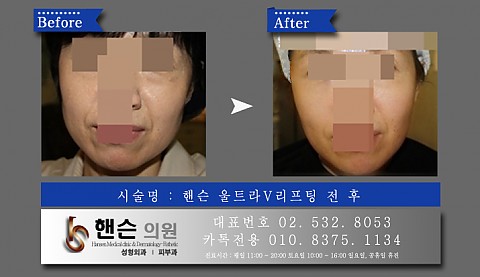 울트라V리프팅 전후사진입니다 