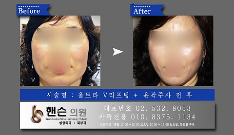 울트라V리프팅+윤곽주사 전후사진입니다 
