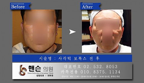 사각턱보톡스 전후사진입니다 