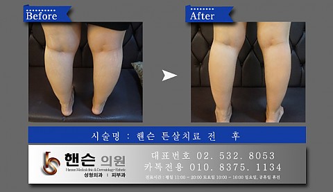 튼살치료 전후사진입니다　　 