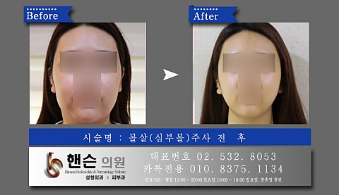 볼살주사 전후사진입니다　　 