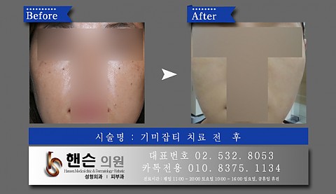 기미잡티치료 전후사진입니다 