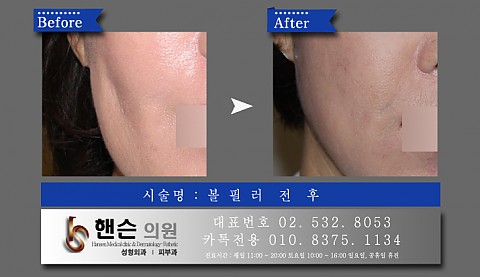 볼필러 전후사진입니다　　　 