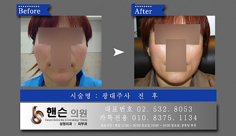 광대주사 전후사진입니다　　 