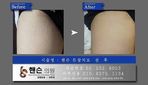 튼살치료 전후사진입니다　　 