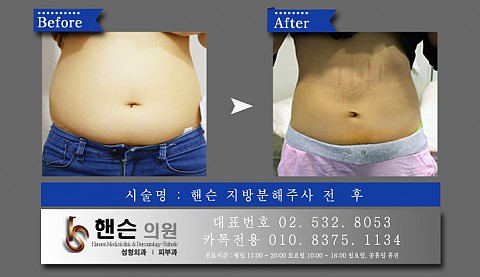 지방분해주사 전후사진입니다 