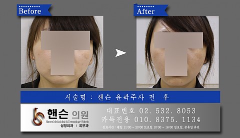 윤곽주사 전후사진입니다 　　 