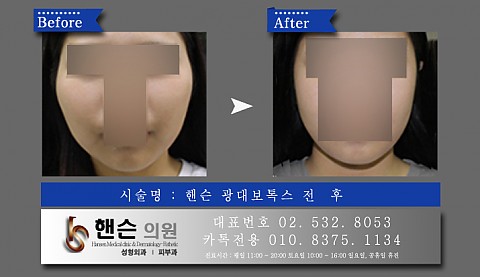 광대보톡스 전후사진입니다 