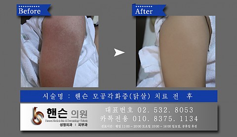 모공각화증(닭살) 치료 전후사진입니다 