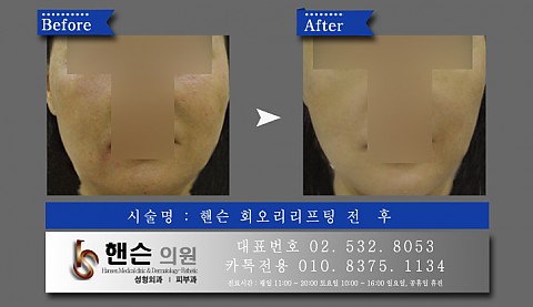 회오리리프팅 전후사진입니다 