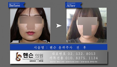 윤곽주사 전후사진입니다　　 