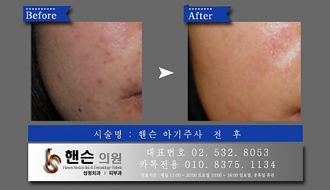 아기주사 전후사진입니다　　 