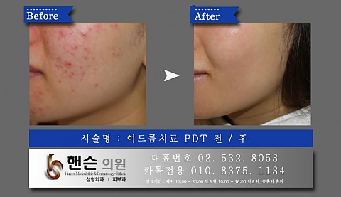 여드름치료 PDT 전후사진입니다 
