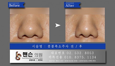 콧볼축소주사 전후사진입니다 