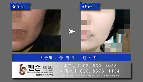 볼필러 전후사진입니다 