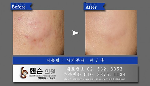 아기주사 전후사진입니다 