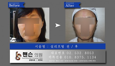 실리프팅 전후사진입니다 
