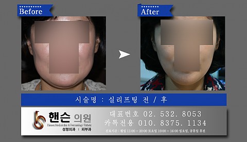 실리프팅 전후사진입니다 