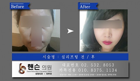 실리프팅 전후사진입니다 