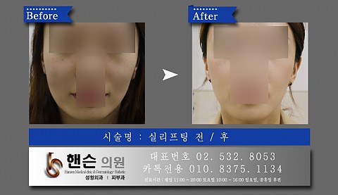 실리프팅 전후사진입니다 