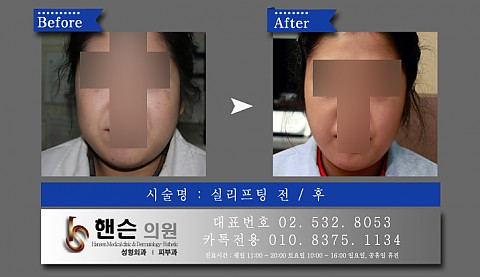 실리프팅 전후사진입니다 