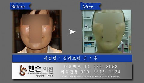 실리프팅 전후사진입니다 