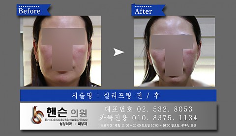 실리프팅 전후사진입니다 