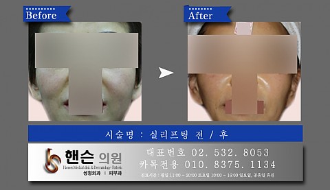 실리프팅 전후사진입니다 