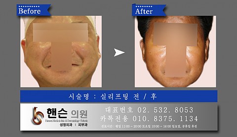 실리프팅 전후사진입니다 