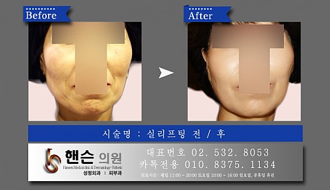 실리프팅 전후사진입니다 