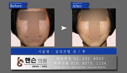 실리프팅 전후사진입니다 