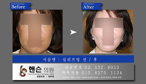 실리프팅 전후사진입니다 