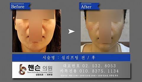 실리프팅  전후사진입니다 