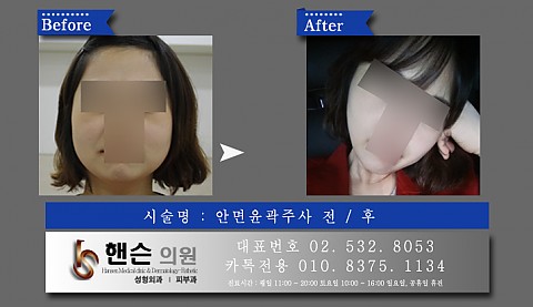 안면윤곽주사 전후사진입니다. 