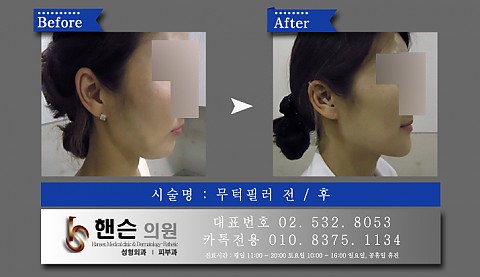 무턱필러 전후사진입니다. 