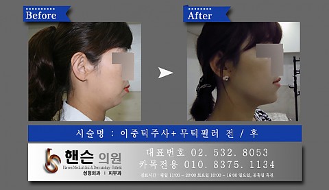 이중턱주사+무턱필러 전후사진 입니다 