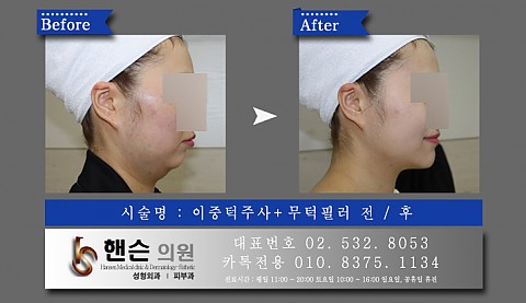 이중턱주사+무턱필러 전후사진 입니다 