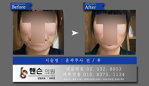 윤곽주사 전후사진 입니다. 