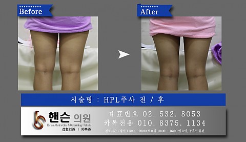 허벅지주사 전후사진입니다. 