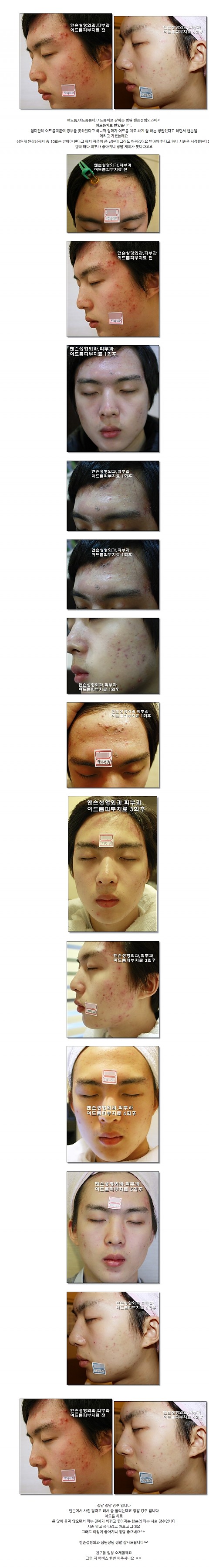 고름이 드륵드륵찬 여드름치료 하고자신감 회복한 후기 입니다 