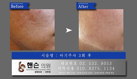아기주사 전후사진입니다 