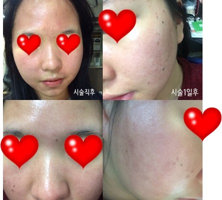 프락셀후기올립니다~ 